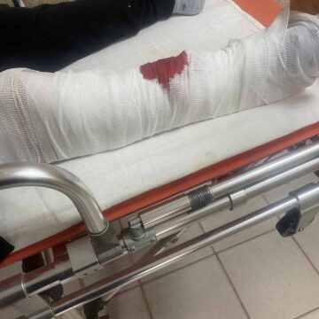 Перелом ноги та інші травми. Мати хлопчика, що потрапив під колеса авто на пішохідному переході в Івано-Франківську шукає юриста для звернення в суд по моральну компенсацію Перелом ноги та інші травми. Мати хлопчика, що потрапив під колеса авто на пішохідному переході в Івано-Франківську шукає юриста для звернення в суд по моральну компенсацію