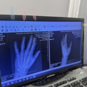 Лікарі ЦМКЛ пришили палець пацієнтові після тяжкої травми