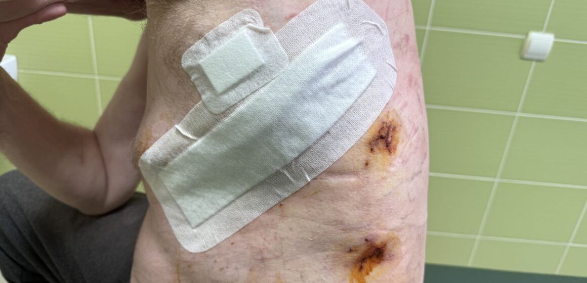 Унікальний випадок: у ЦМКЛ врятували 52-річного пацієнта з розривом грудного лімфатичного протоку у двох місцях