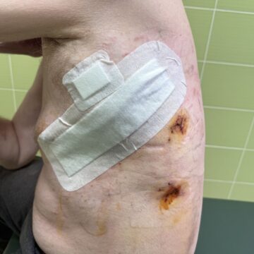 Унікальний випадок: у ЦМКЛ врятували 52-річного пацієнта з розривом грудного лімфатичного протоку у двох місцях