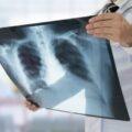 На Прикарпатті у серпні зареєстрували 32 випадки туберкульозу